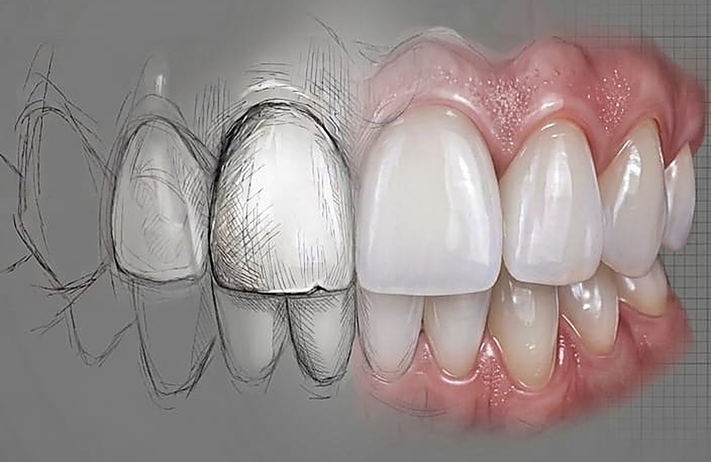 An illustration of a smile designed in stages — from an initial line drawing through to the finished ceramic result
